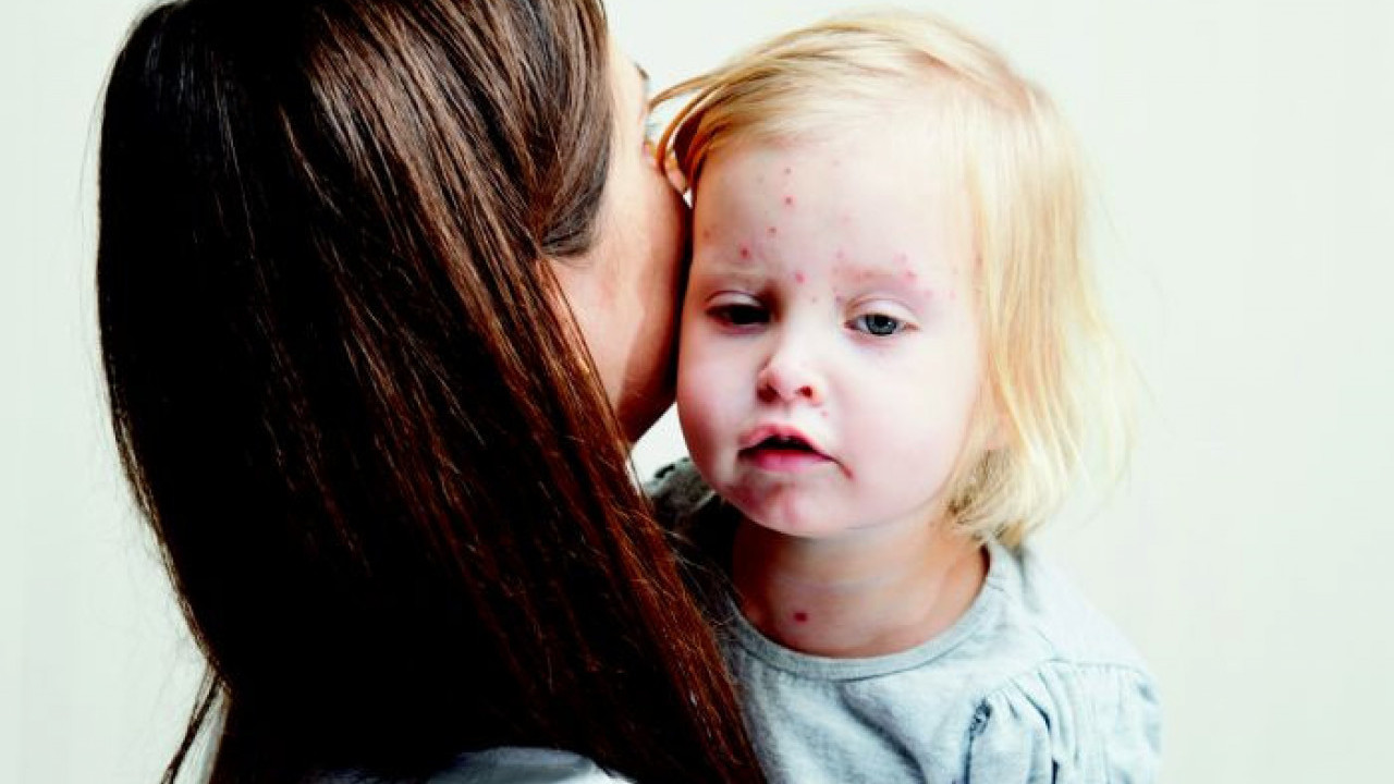 ALERGIJA ILI VIRUS? Kako razlikovati promene na koži