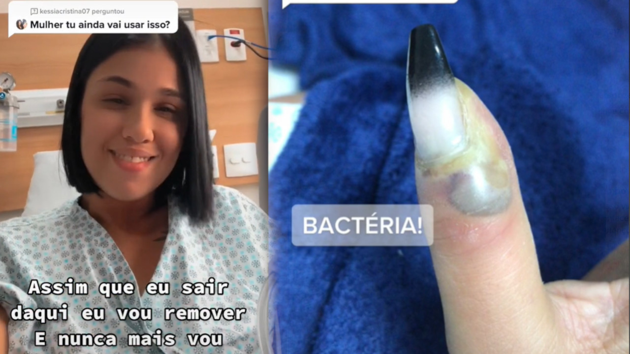 UŽAS! Tiktokerka lepila lažni nokat - AMPUTIRALI joj prst