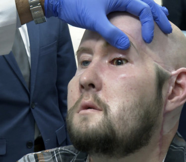 PRVA TRANSPLATACIJA OKA Struja veteranu iz SAD uništila lice