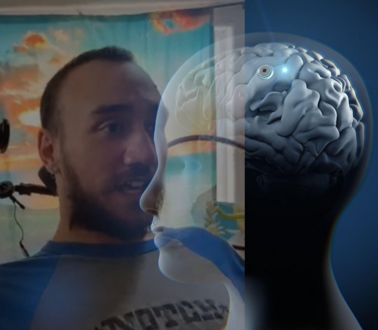 Objavljen snimak prvog čoveka sa ugrađenim ČIPOM u mozgu