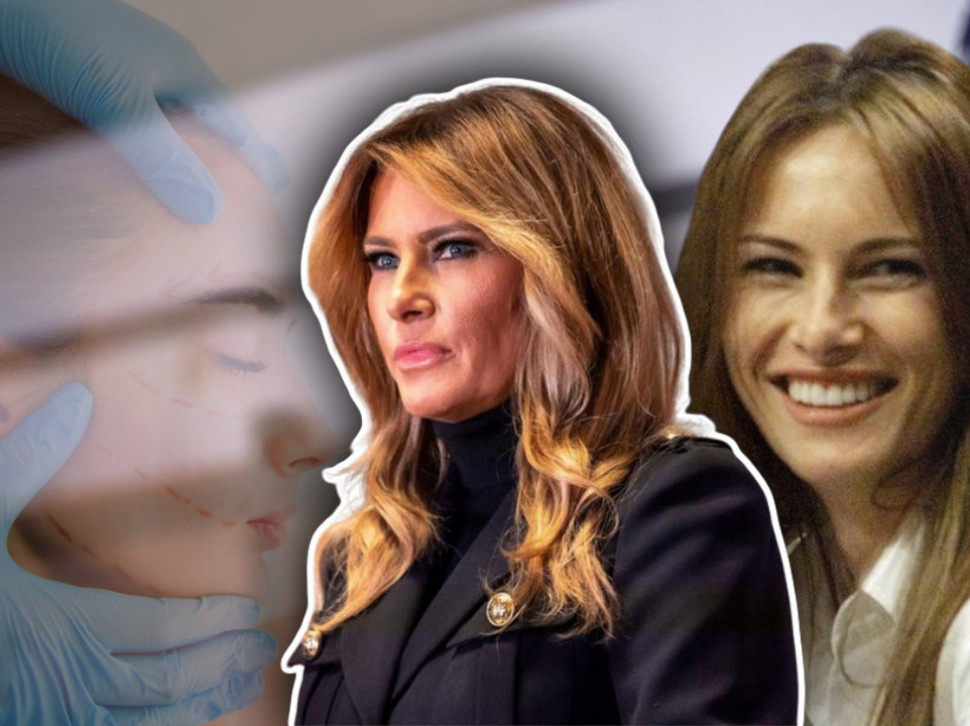 SLIKA IZ MLADOSTI: Melanija ipak nije prirodna lepotica?