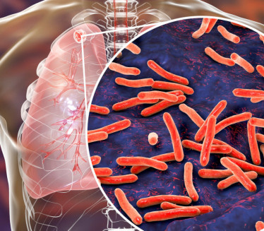 СЗО ЗАБРИНУТ: Више од 8 милиона оболело од туберкулозе