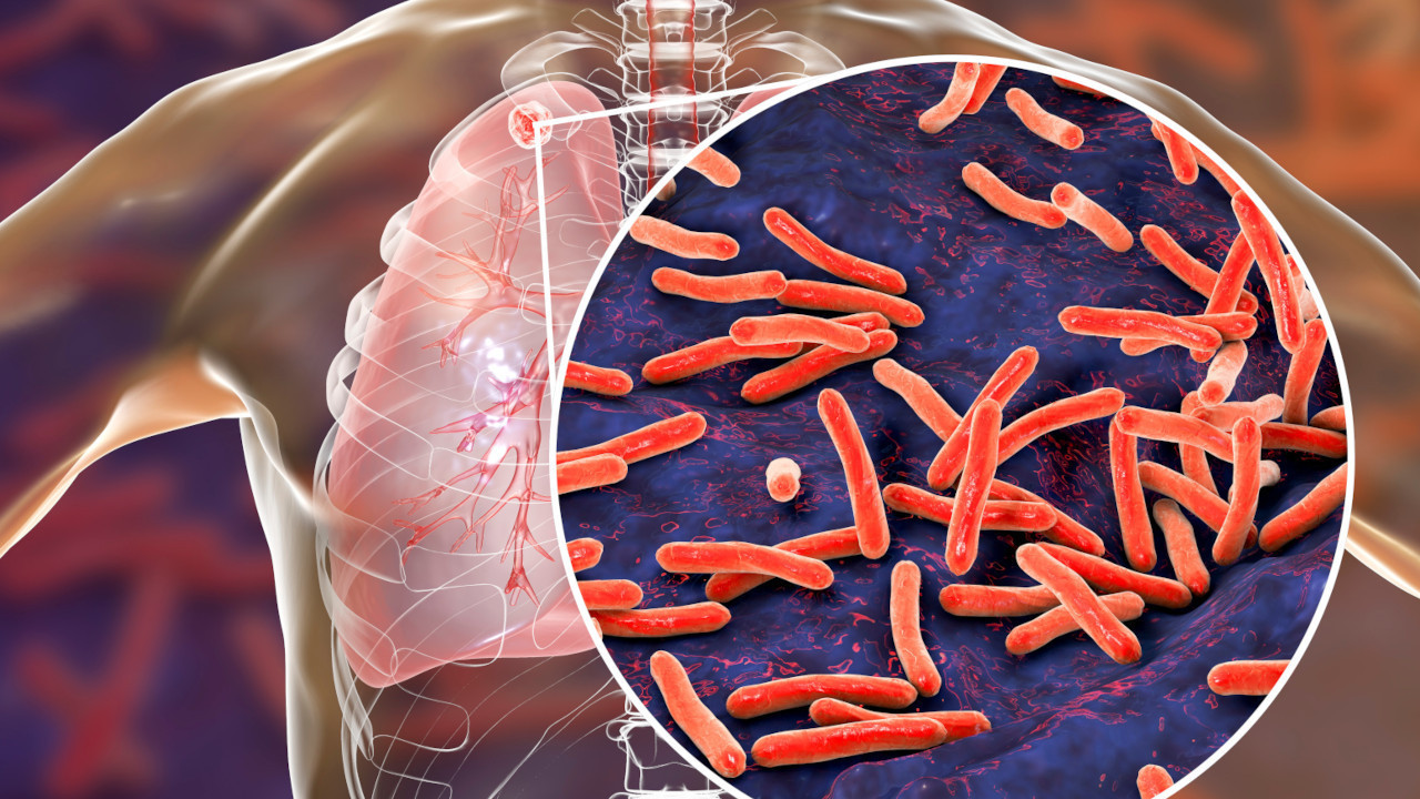 SZO ZABRINUT: Više od 8 miliona obolelo od tuberkuloze