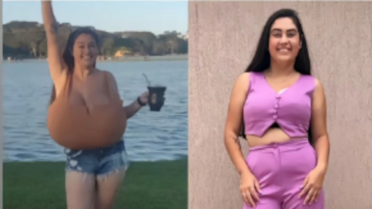 LEKARI U ŠOKU: Grudi joj narasle do 12kg za nekoliko meseci