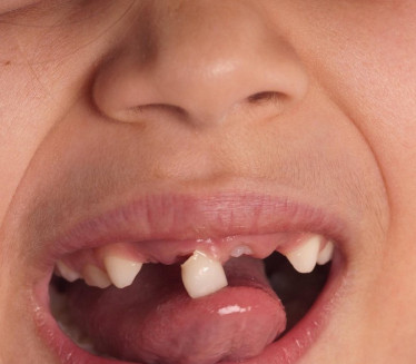 Šta znači kad sanjate da vam ispadaju ili se lome zubi?