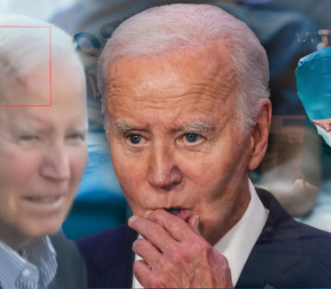 GOLEM OŽILJAK NA ČELU Kako Bajden izgleda nakon uklanjanja raka