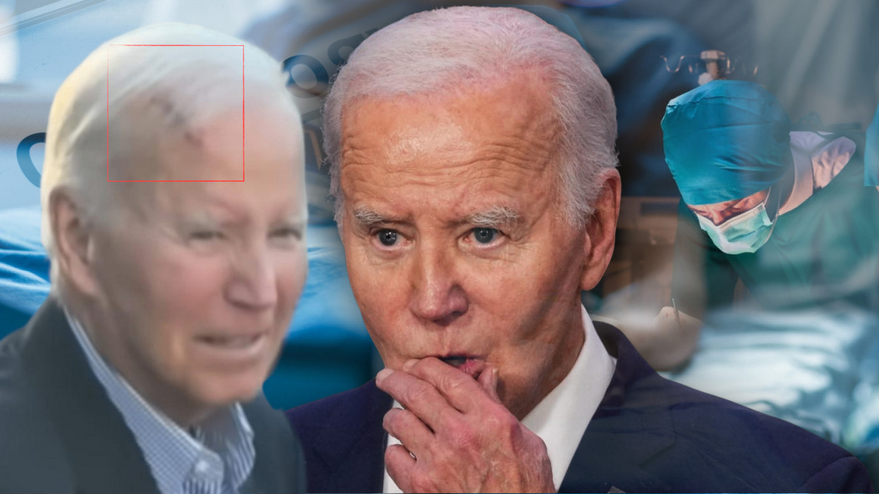 GOLEM OŽILJAK NA ČELU Kako Bajden izgleda nakon uklanjanja raka