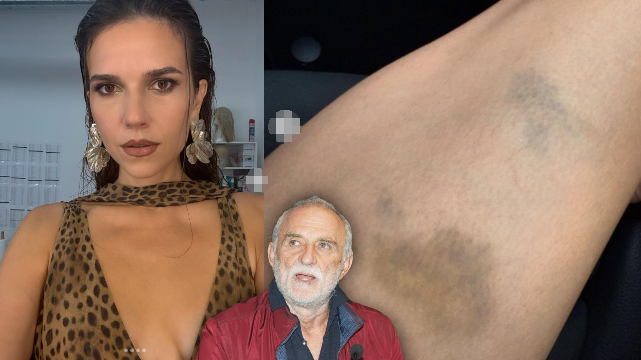 СВЕ ИЗНЕЛА ЈАВНО Аница објавила фотке у модрицама: "Боли!"