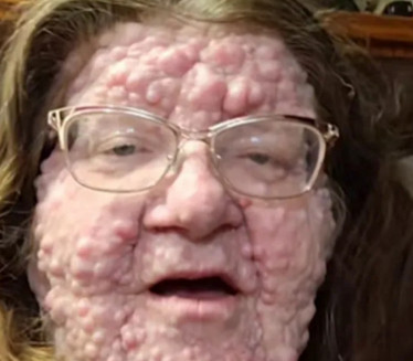 U BOLNICI SAZNALA TEŠKU ISTINU: Živi sa 200 tumora na licu