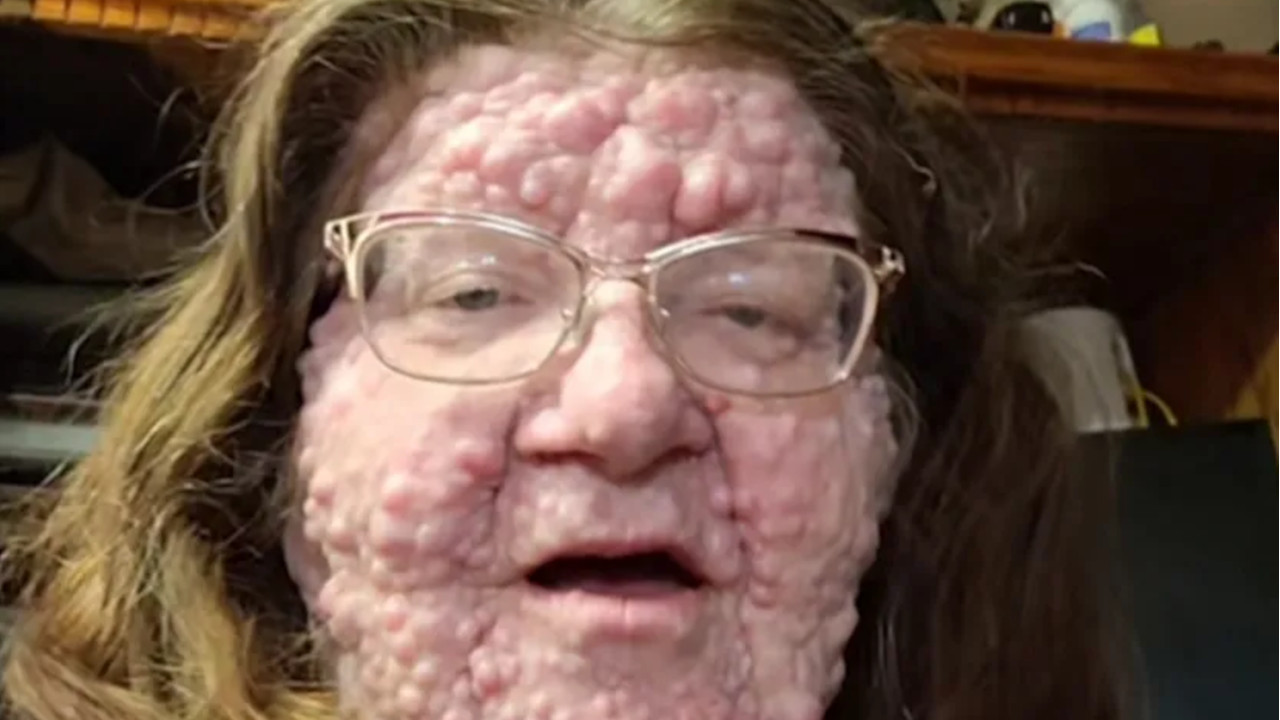 U BOLNICI SAZNALA TEŠKU ISTINU: Živi sa 200 tumora na licu