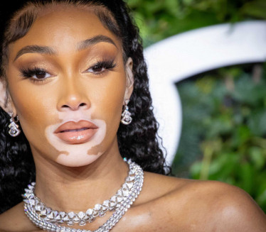 BOLEST JE PROSLAVILA: Nazivali je zebrom, izrasla u lepoticu