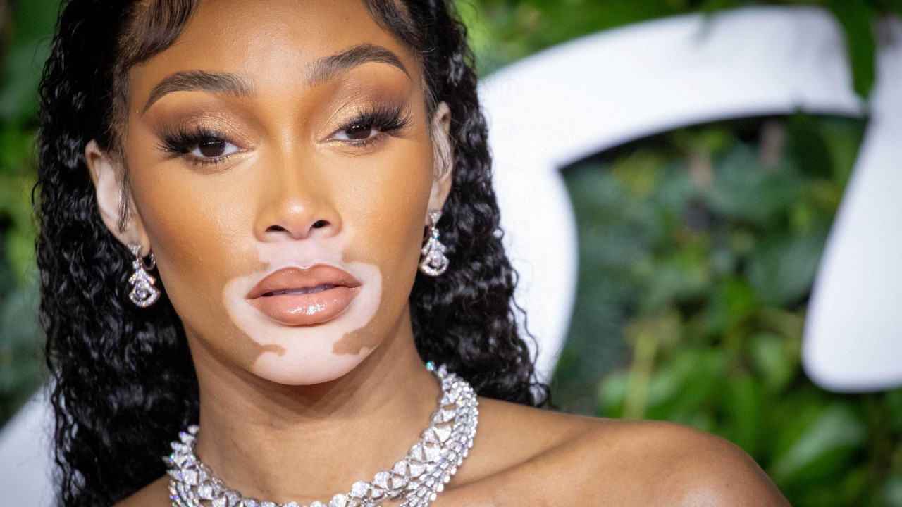 БОЛЕСТ ЈЕ ПРОСЛАВИЛА: Називали је зебром, израсла у лепотицу