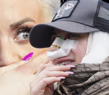 NOS MI SE URUŠIO! Dušica izdeformisana - mora pod nož 7 put