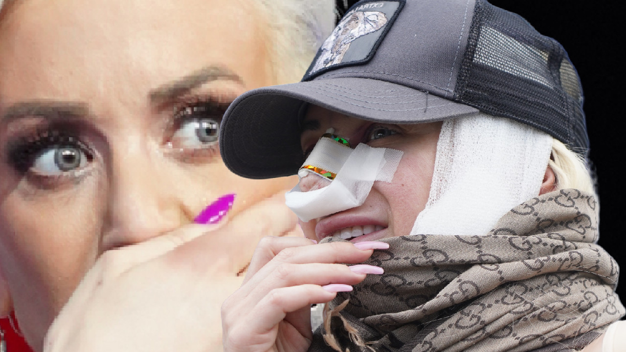 NOS MI SE URUŠIO! Dušica izdeformisana - mora pod nož 7 put