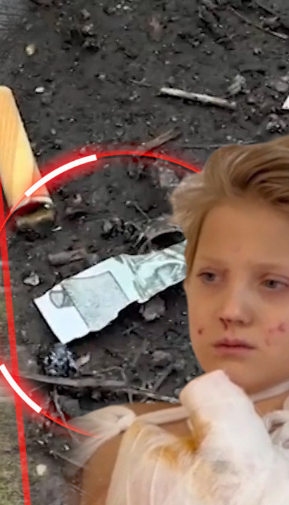 Dečak (10)uzeo novčanicu na ulici,eksplodirala-izgubio prste