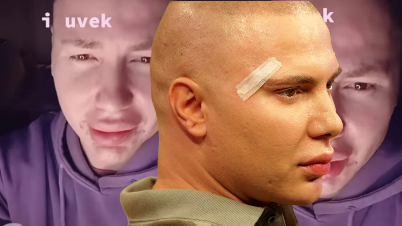 "У ПРОЦЕСУ САМ ЛЕЧЕЊА ЛИЦА" : Брендон сав у крастама