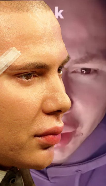 "У ПРОЦЕСУ САМ ЛЕЧЕЊА ЛИЦА" : Брендон сав у крастама