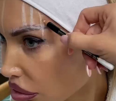TRANSPLANTACIJA OBRVA Eyebrow Advance metoda - najbolji izbor