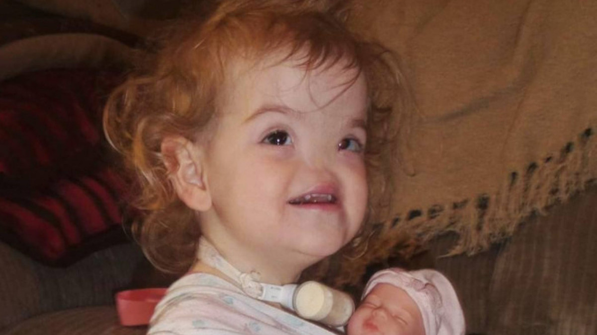 PRVA BEBA ROĐENA BEZ NOSA Danas ima 12leta- evo kako izgleda