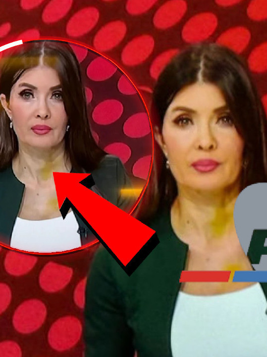 Voditeljka u modricama vodila "Dnevnik" - gledaoci zabrinuti